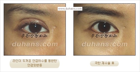 [두한성형외과 경쟁력 눈성형] - [Dr. 컬럼  "어떤 쌍꺼풀이 아름다운 쌍꺼풀인가?!] 관련 이미지 6