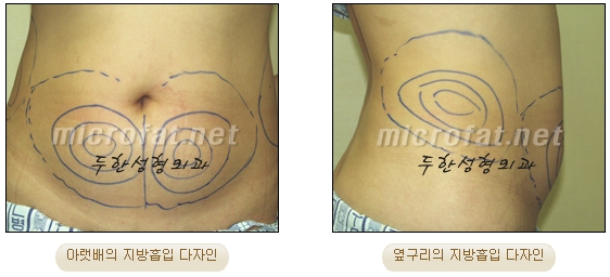 두한성형외과 지방흡입 - 부위별 안전 지방흡입 관련 이미지 6