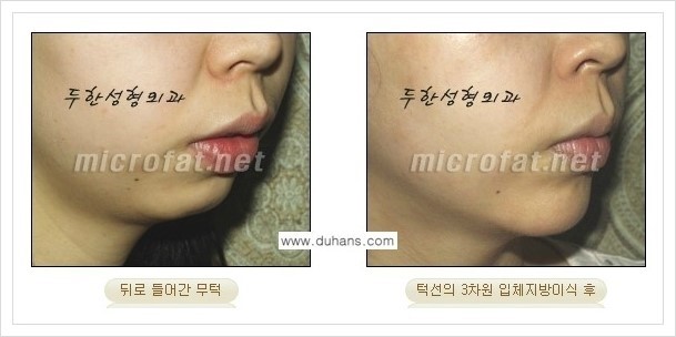 ⁠⁠[두한성형외과 경쟁력 미세지방이식] - [턱 미세지방이식 - 안면윤곽 교정 안내] 관련 이미지 16