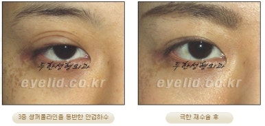 Duhan Plastic Surgery Ophthalmic Reoperation - What Is a Successful Double Eyelid Revision Surgery? image 23