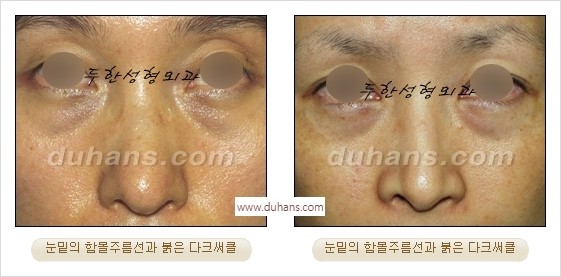 [두한성형외과 경쟁력 안검성형] - [젊은 눈매 안검성형의 여러 가지 방법 안내] 관련 이미지 53