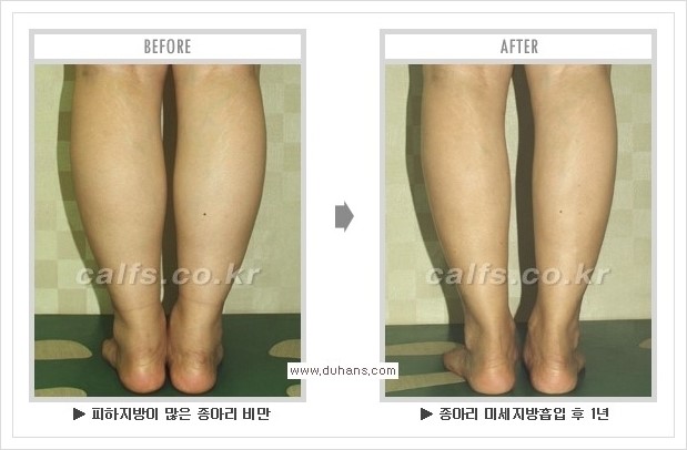[두한성형외과 경쟁력 멀티종아리성형] - [종아리성형 방법별 전후 주의사항] 관련 이미지 29