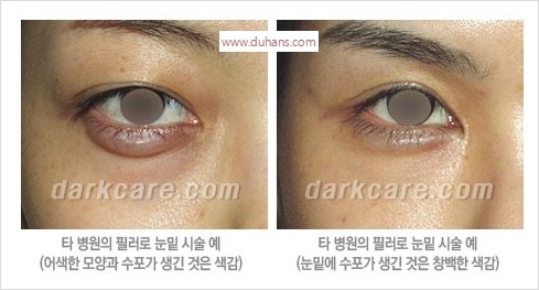 [두한성형외과 경쟁력 눈밑성형] - [다크써클 치료 실패의 원인 - 레이저 치료, 필러로 교정, 잘못된 적응증의 지방재배치] 관련 이미지 4
