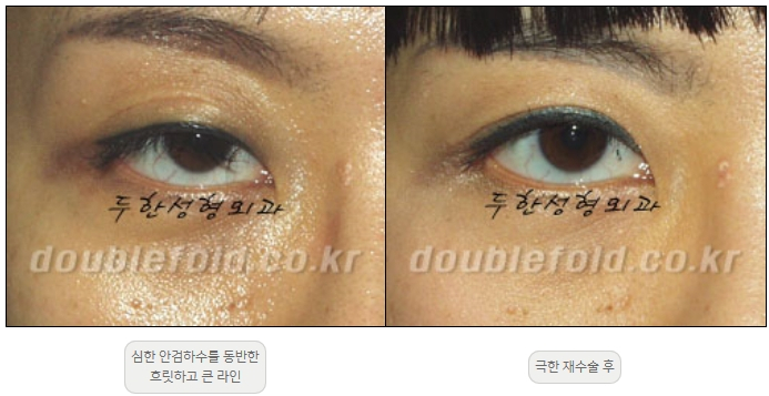 [Duhan Plastic Surgery Double Eyelid Revision] - [Thick Double Eyelid Line] image 52