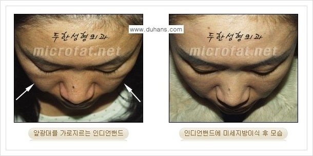 [두한성형외과 경쟁력 미세지방이식] - [귀족수술과 인디언밴드 교정 안내] 관련 이미지 7