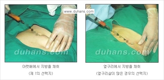 [두한성형외과 NO.1 지방이식]-[두한 지방이식 클리닉의 특징] 관련 이미지 5