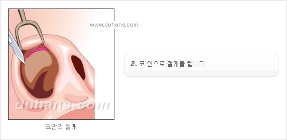 [두한성형외과 경쟁력 코성형] - [코성형을 위한 알로덤(슈어덤) 수술, 실리콘 수술 안내] 관련 이미지 5