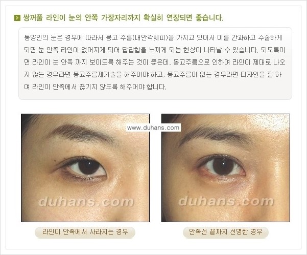 ​[두한성형외과 경쟁력 눈성형] - [자연스럽고 아름다운 쌍꺼풀의 기준] 관련 이미지 2