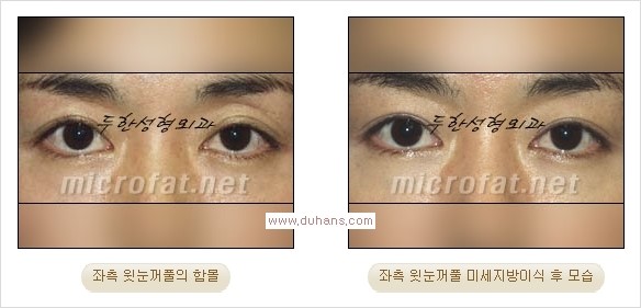 [두한성형외과 경쟁력 쌍꺼풀 재수술, 극한 눈재수술] - [어색한 쌍꺼풀 라인을 교정하는 윗눈꺼풀 미세지방이식] 관련 이미지 13