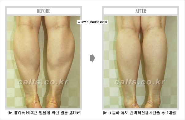 [두한성형외과 경쟁력 멀티종아리성형] - [종아리성형 전후 주의해야 할 내용 안내] 관련 이미지 9