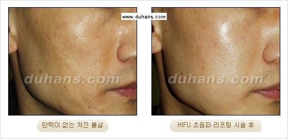 [두한성형외과 경쟁력 주름성형] - [UP되는 HIFU초음파 리프팅 주름교정] 관련 이미지 24