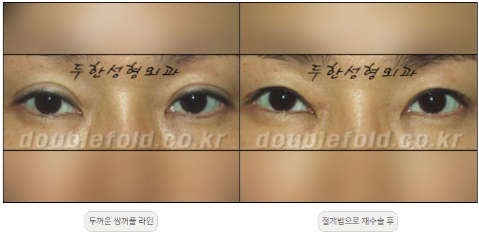 [Duhan Plastic Surgery Double Eyelid Revision] - [Thick Double Eyelid Line] image 14
