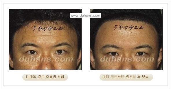[두한성형외과 경쟁력 주름성형] - [엔도타인 리프팅 안내 ②] 관련 이미지 17