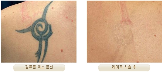 Duhan Plastic Surgery Laser Treatment - Mole Removal, Spot Removal, Melasma, Blemishes, Hyperpigmentation, Skin Tone Improvement, Elasticity Improvement, Skin Texture Improvement image 25