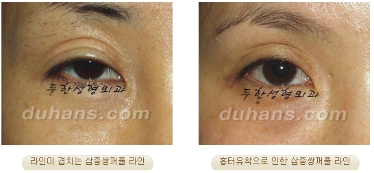 눈성형잘하는곳 두한성형외과 - 겹쌍꺼풀 관련 이미지 4