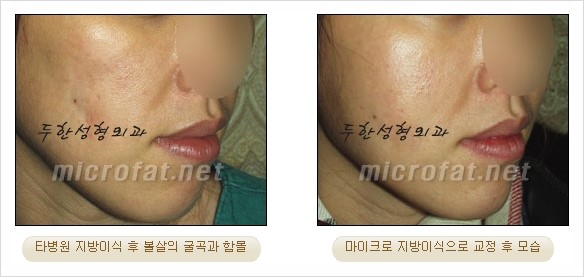 [두한성형외과 경쟁력 지방이식 리더] - [Col-fat(콜펫)지방이식, 3차원 입체지방이식, 2차원 평면지방이식] 관련 이미지 48