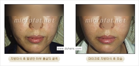 [두한성형외과 경쟁력 미세지방이식] - [지방이식 부작용 - 지방이식 후 발생한 굴곡현상에 대한 안내] 관련 이미지 5
