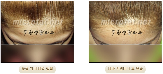 이마성형 두한성형외과 - 이마주름, 이마지방이식 관련 이미지 15