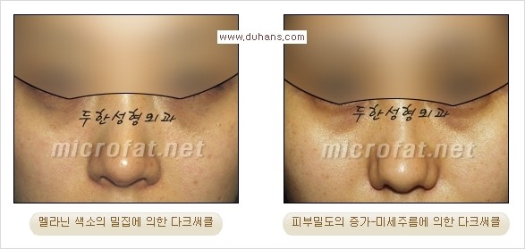 [두한성형외과 경쟁력 눈밑성형] - [Dr. 컬럼 - 눈밑 다크써클의 치료 방법과 치료 효과] 관련 이미지 16