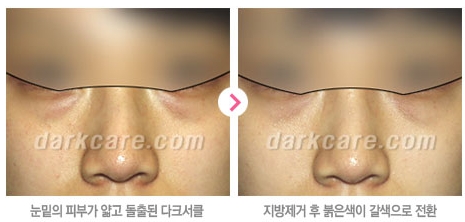 [두한성형외과 눈밑성형] - [다크서클 치료 실패] 관련 이미지 9