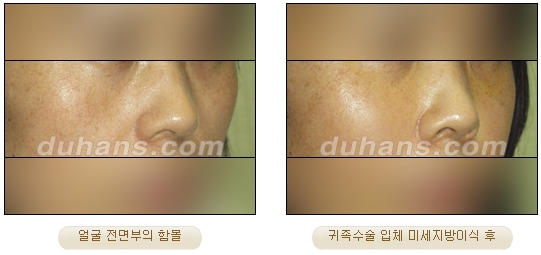 [Duhan Plastic Surgery Facial Autologous Fat Grafting] - [Fat Grafting Guide] image 9