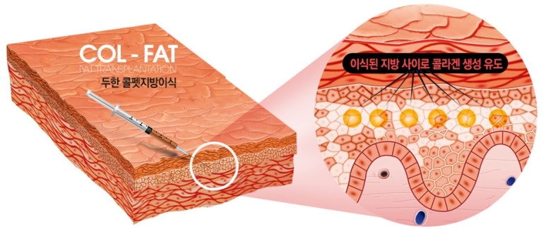 두한성형외과 눈밑성형 - 애교필러 후 눈밑재수술 관련 이미지 9
