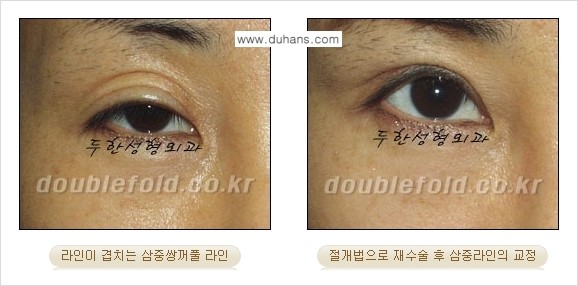 ⁠[두한성형외과 경쟁력 쌍꺼풀 재수술, 극한 눈재수술] - [삼중(세겹) 쌍꺼풀 라인의 교정] 관련 이미지 7