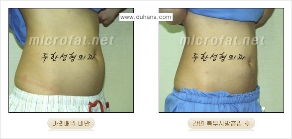 [두한성형외과 겨울엔 지방흡입] - [간편한 복부지방흡입 도전 2.] 관련 이미지 7