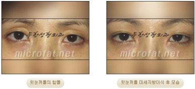 [Doohan Plastic Surgery Autologous Fat Grafting] - [Sunken Eye Fat Grafting] image 27