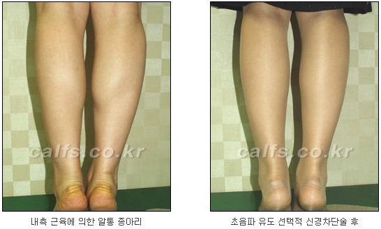 [두한성형외과 종아리퇴축술] - [NO절개! 초음파유도신경차단술] 관련 이미지 23