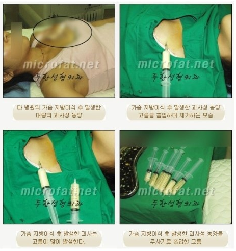 [두한성형외과 지방이식] - [전후절차, 시술후 관리요령, 흔한질문답변, 지방이식에 대한 잘못된 지식] 관련 이미지 36