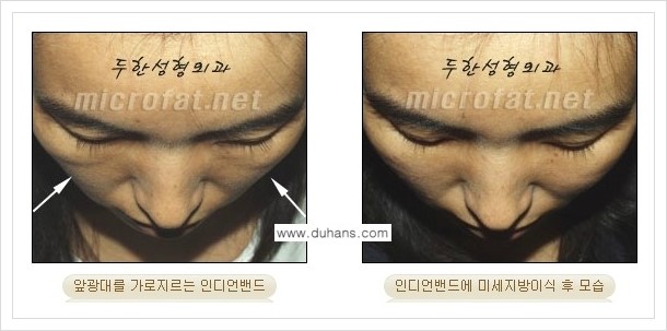 [두한성형외과 경쟁력 미세지방이식] - [귀족수술과 인디언밴드(앞광대주름) 미세지방이식] 관련 이미지 16