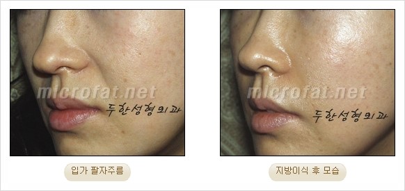 [두한성형외과 경쟁력 지방이식 리더] - [Col-fat(콜펫)지방이식, 3차원 입체지방이식, 2차원 평면지방이식] 관련 이미지 42