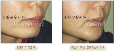 [Duhan Plastic Surgery Clinic Microgenia Correction] - [Chin Microfat Grafting] image 14