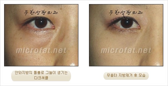 [두한성형외과 쌍커풀수술] - [눈성형 방법에 대한 자주하는 질문과 답변] 관련 이미지 192