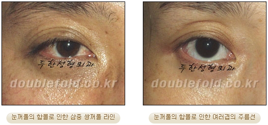 [두한성형외과 눈재수술] - [재수술 방법들] 관련 이미지 26