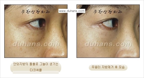 [두한성형외과 젊은 눈매 안검성형] - [눈밑 지방제거의 수술 전후 안내 ①] 관련 이미지 13