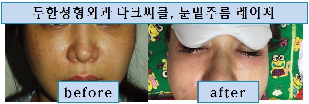 두한성형외과 - 눈밑레이저, 주름레이저, 레이저치료 ,눈밑주름,눈가주름, 눈주름, 잔주름, 깊은주름, 주름, 주름개선, 주름교정 관련 이미지 3