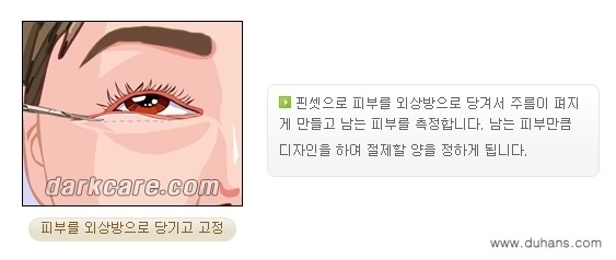 ​[두한성형외과 NO.1 다크써클 교정] - [하안검 성형술 + 눈밑지방 재배치] 관련 이미지 7