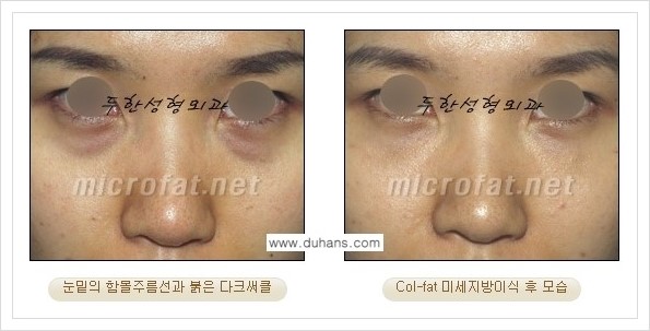 [두한성형외과 경쟁력 눈밑성형] - [눈밑 다크써클과 눈밑 함몰주름의 최적화 교정방법 안내] 관련 이미지 9