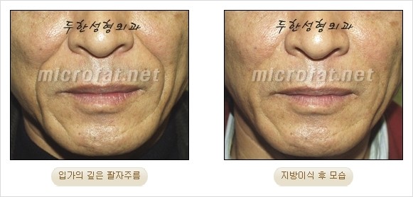 [두한성형외과 경쟁력 안티에이징 동안성형] - [주름이 깊은 푹~ 꺼진 입가 팔자주름 안녕!] 관련 이미지 22