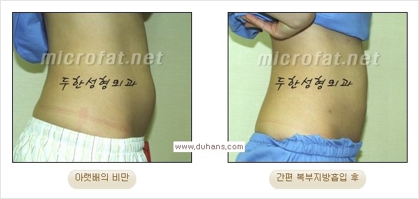 [두한성형외과 경쟁력 간편지방흡입] - [복부(뱃살) 비만 간편지방흡입] 관련 이미지 20