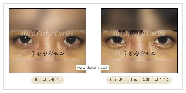 [두한성형외과 경쟁력 눈밑성형] - [애교살과 다크써클과의 관계] 관련 이미지 12