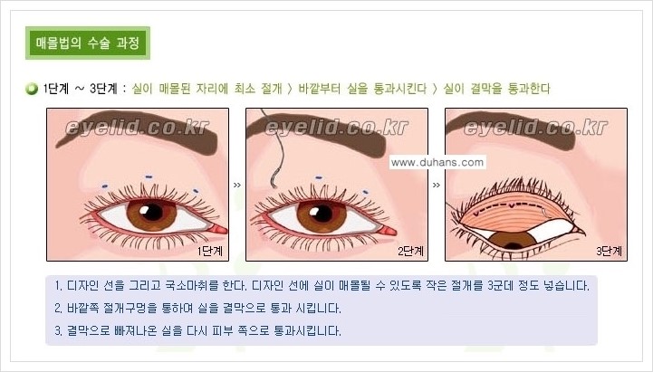 [두한성형외과 경쟁력 눈성형] - [절개법, 매몰법 쌍꺼풀 수술 안내] 관련 이미지 6