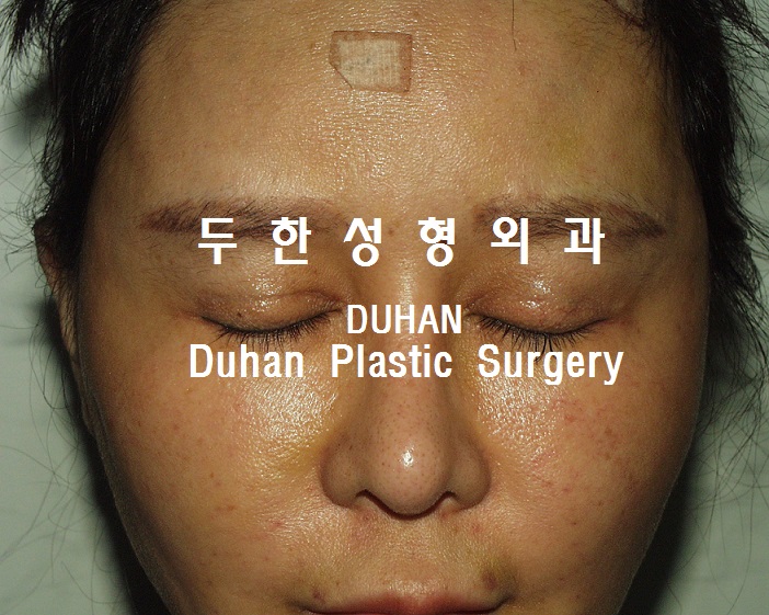 #쌍꺼풀재수술 지방전진 #재배치 를 통해 라인 자연스럽게 낮추기, #눈재수술 #인라인 관련 이미지 2