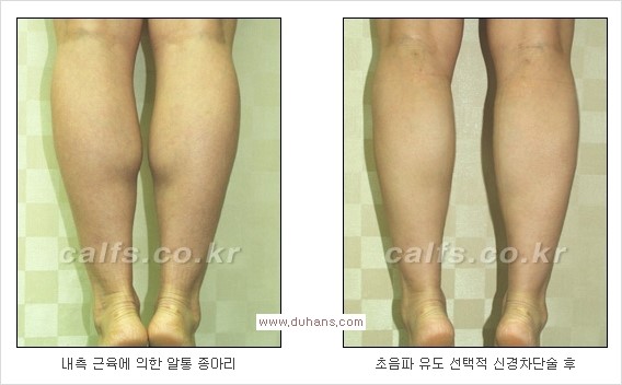 ⁠[두한성형외과 경쟁력 종아리성형] - [종아리퇴축술 - 비절개 초음파 유도 선택적 신경차단술 장비 안내] 관련 이미지 10