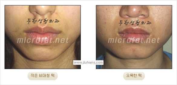 [두한성형외과 경쟁력 안면윤곽 교정] - [미세지방이식으로 무턱, 작은턱, 오목턱, 턱선의 비대칭 교정 안내] 관련 이미지 1