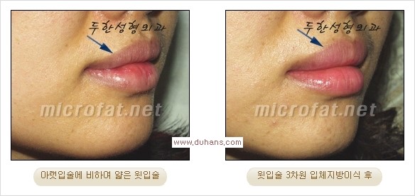 [두한성형외과 경쟁력 미세지방이식] - [입술 3차원 입체지방이식 안내 1.] 관련 이미지 16