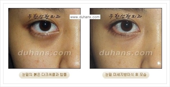 [두한성형외과 경쟁력 눈밑성형] - [다크써클과 눈밑주름을 위한 미세지방이식 안내] 관련 이미지 3