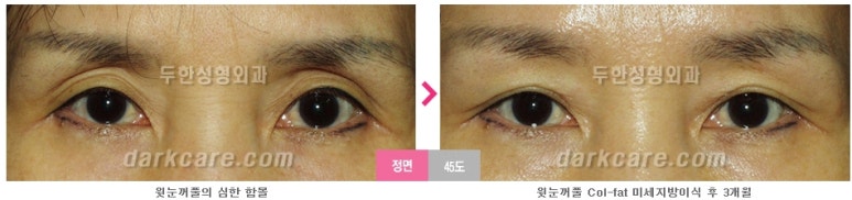[두한성형외과 다크서클] - [다크서클 전후사진 검증] 관련 이미지 174